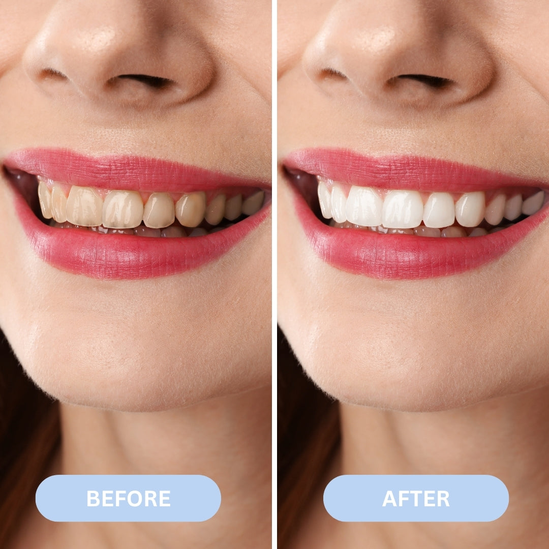 Aurize Cavity Healing Tooth Armor